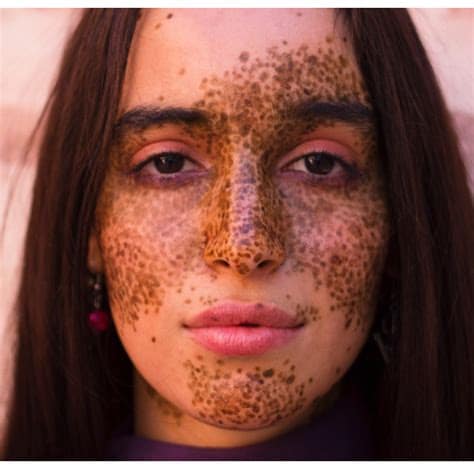 ☀️ Xeroderma Pigmentoso: A Doença Rara que Transforma o Sol em Inimigo