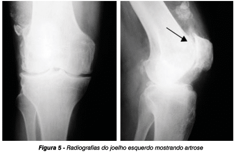 Radiografia mostrando os danos nas articulações de um paciente com alcaptonúria.