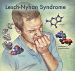 🧬 Síndrome de Lesch-Nyhan: O Enigma Genético que Desafia o Corpo e a Mente