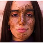 ☀️ Xeroderma Pigmentoso: A Doença Rara que Transforma o Sol em Inimigo